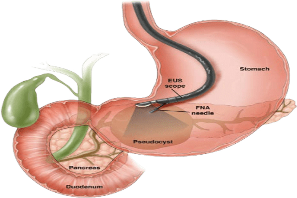 Endoscopic Ultrasound Doctor In Mumbai | Dr Dipak