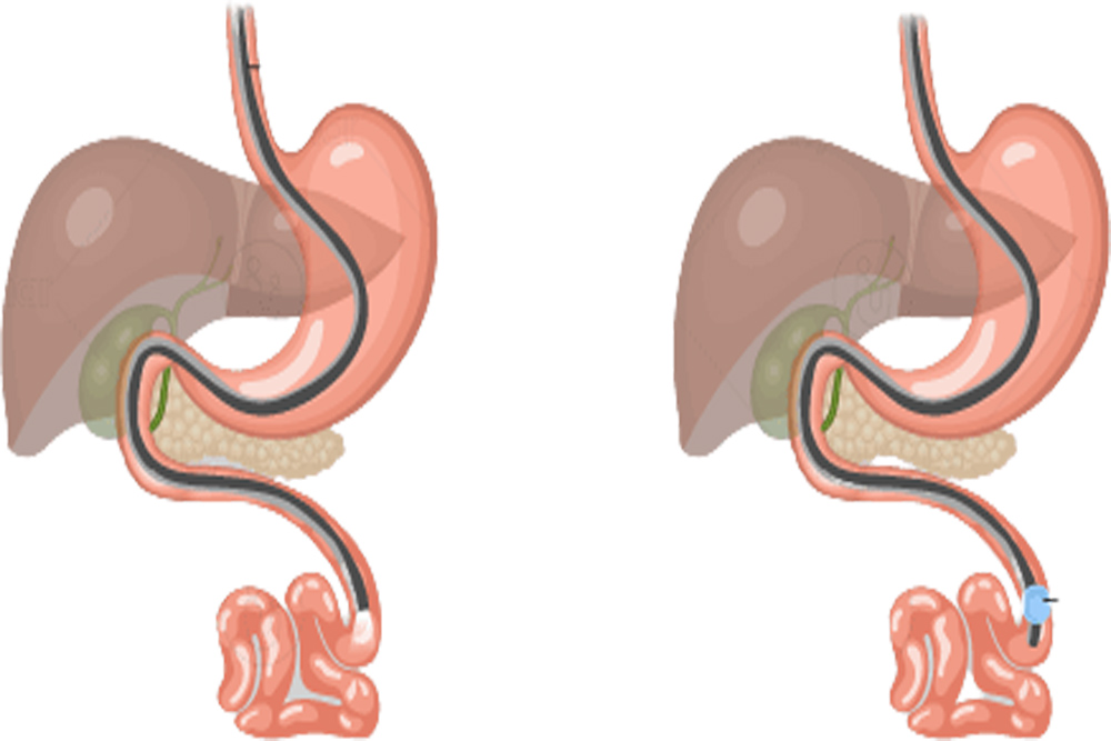 Enteroscopy Treatment In Mumbai I Dr Dipak Bhangale