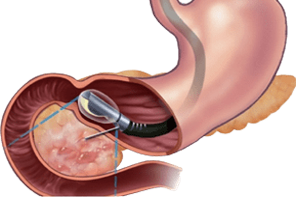 Endoscopy Cost in Navi Mumbai | Dr Dipak Bhangale